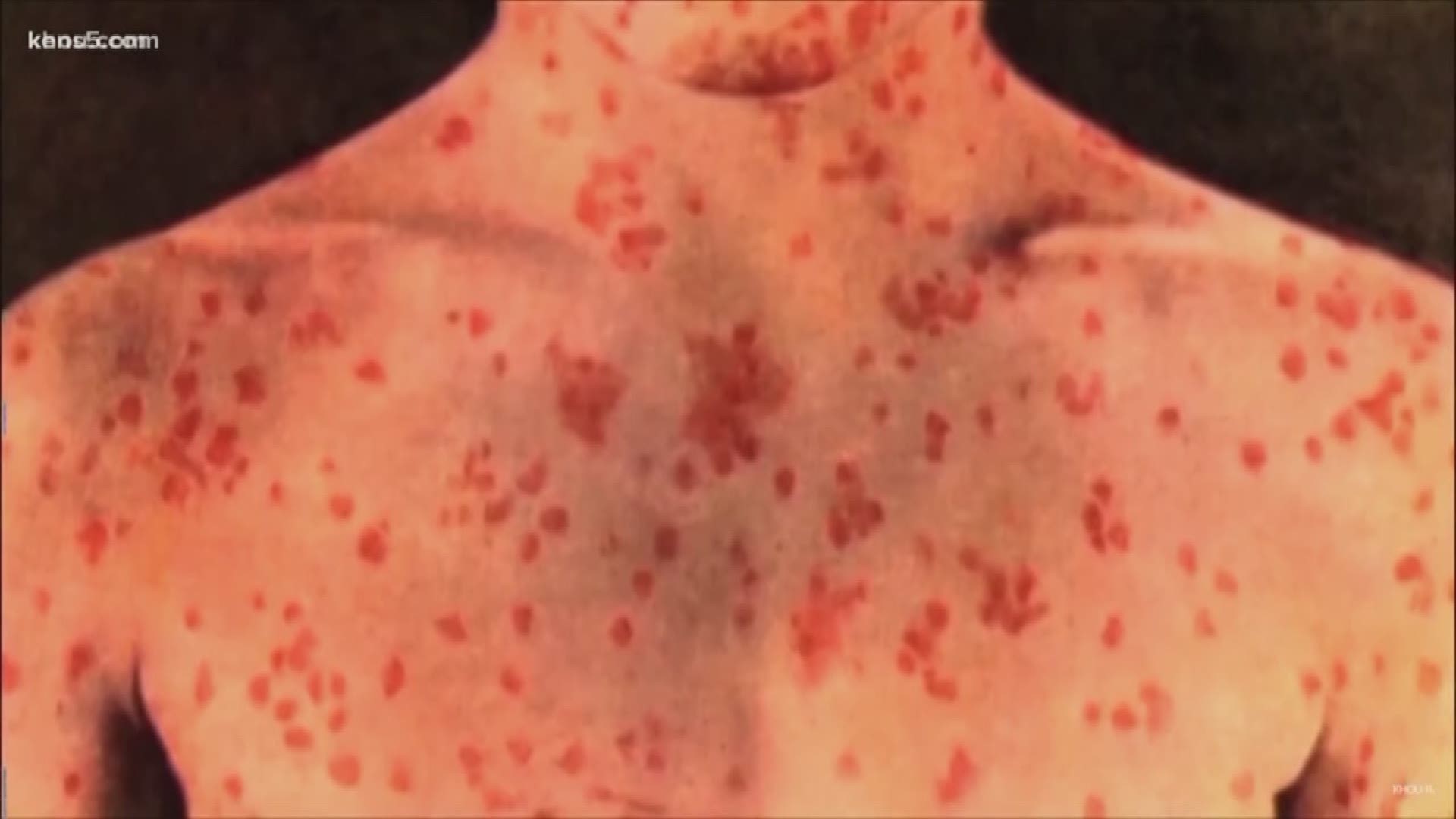 Officials added this is “associated” with a case of measles from Guadalupe County that was confirmed and reported by KENS 5 in early March. The disease had been traveling across the U.S. at a record pace this year; 25 percent of those who get measles end up going to the hospital.