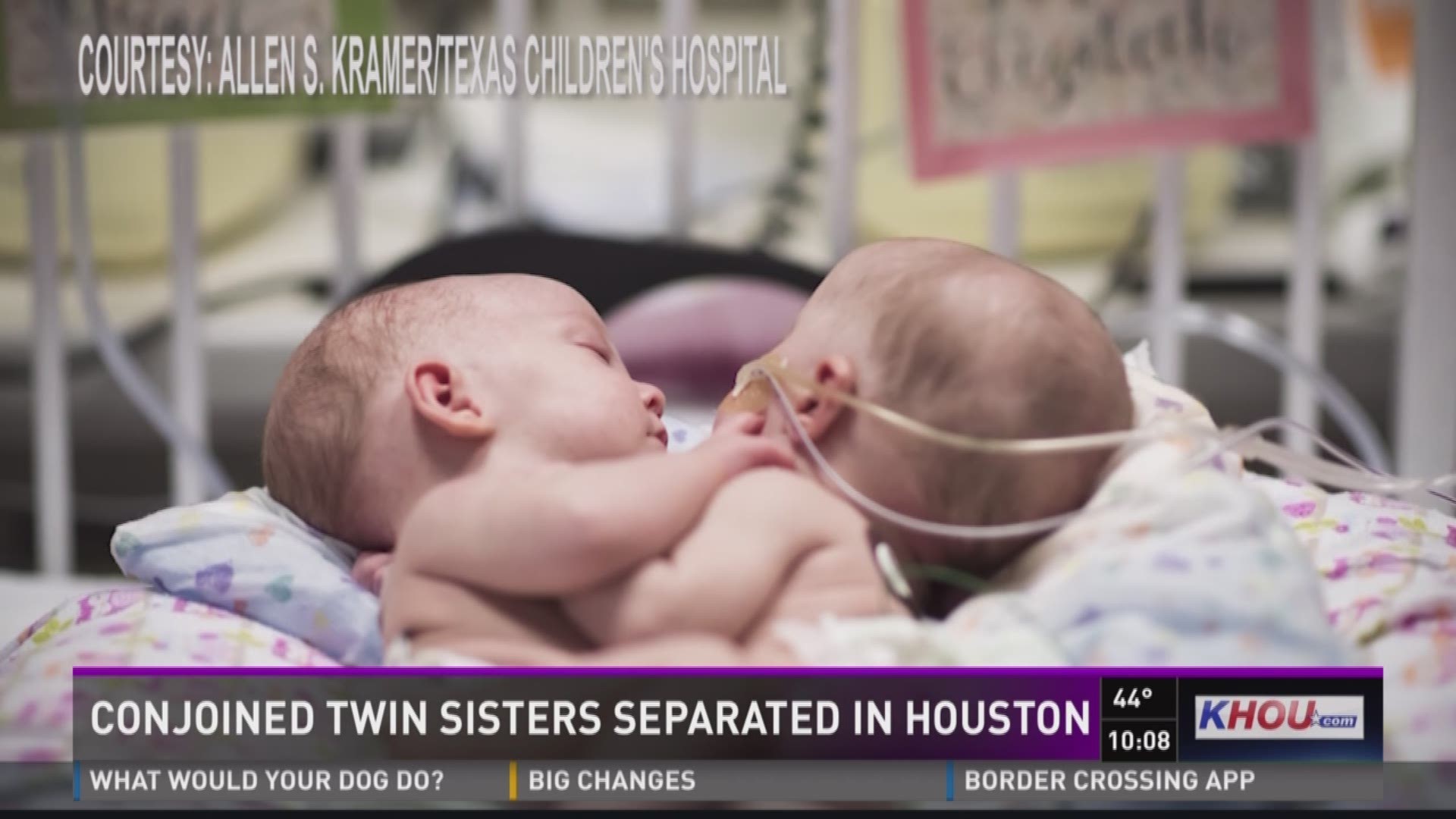 Conjoined identical twin girls have been successfully separated at Texas Children's Hospital.