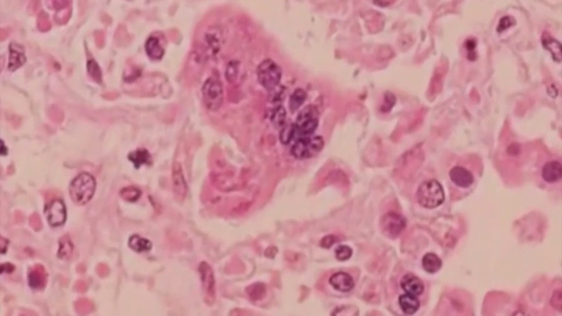 First measles death reported in West Texas outbreak is an unvaccinated ...