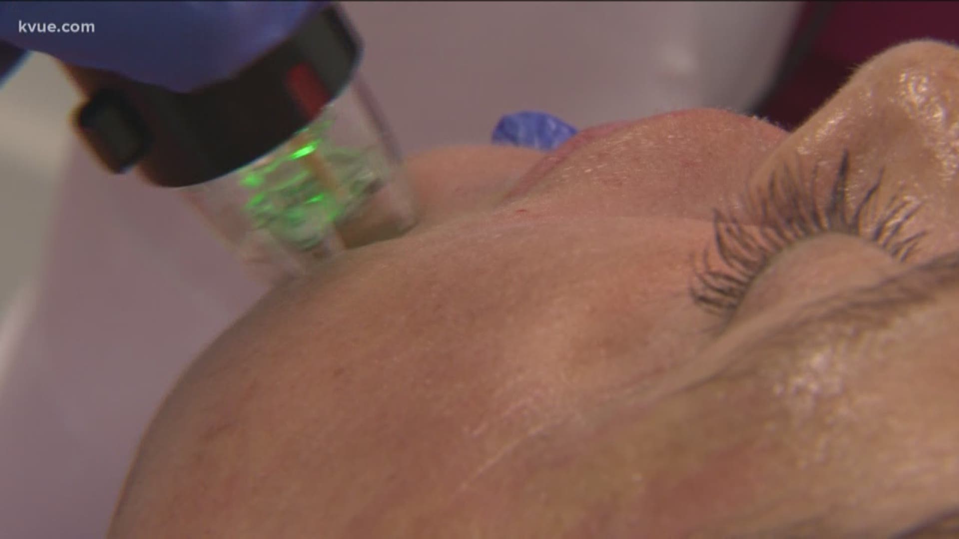 Dermatologists say a new machine can help reduce wrinkles, stretch marks and scars in as little as three weeks by combining micro-needling, radiofrequency and a redefined technology.