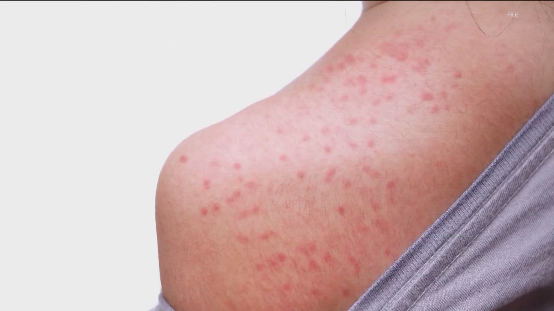 The Texas Department of State Health Services has released new case numbers, sharing that West Texas now has 259 confirmed measles cases.