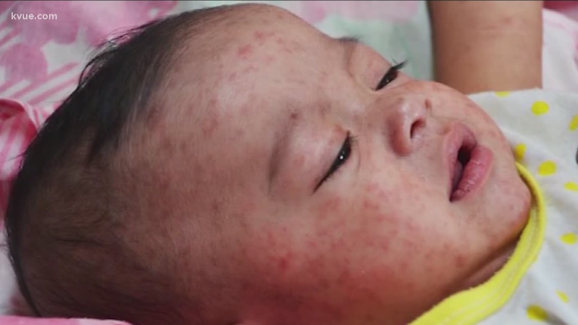 It looks like the measles have made their way to Central Texas. The state health department said there are two possible cases in the region now.