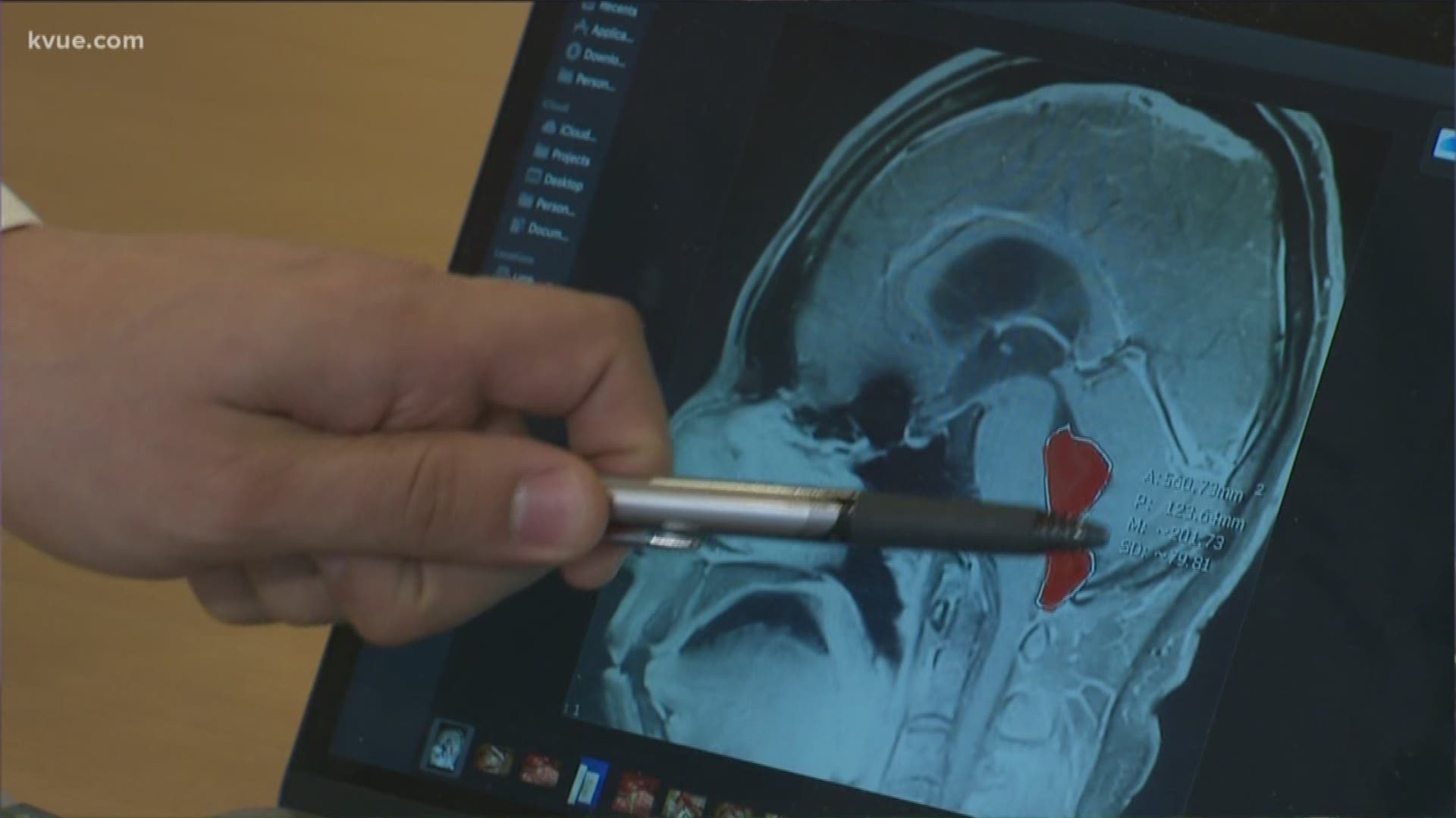 A Central Texas man is feeling much better after doctors took a tapeworm out of his brain.