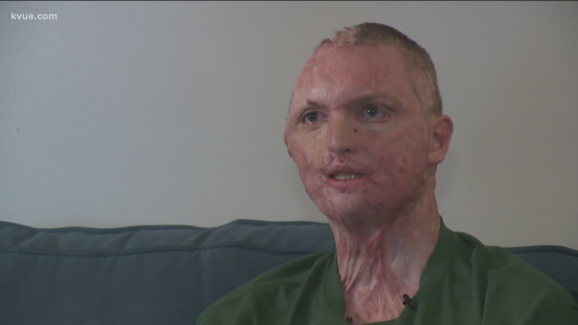 Zachary Sutterfield, who survived the fire at the Iconic Village Apartment in San Marcos with burns on nearly 70% of his body, walks us through the heartbreaking divide between his life before and after.