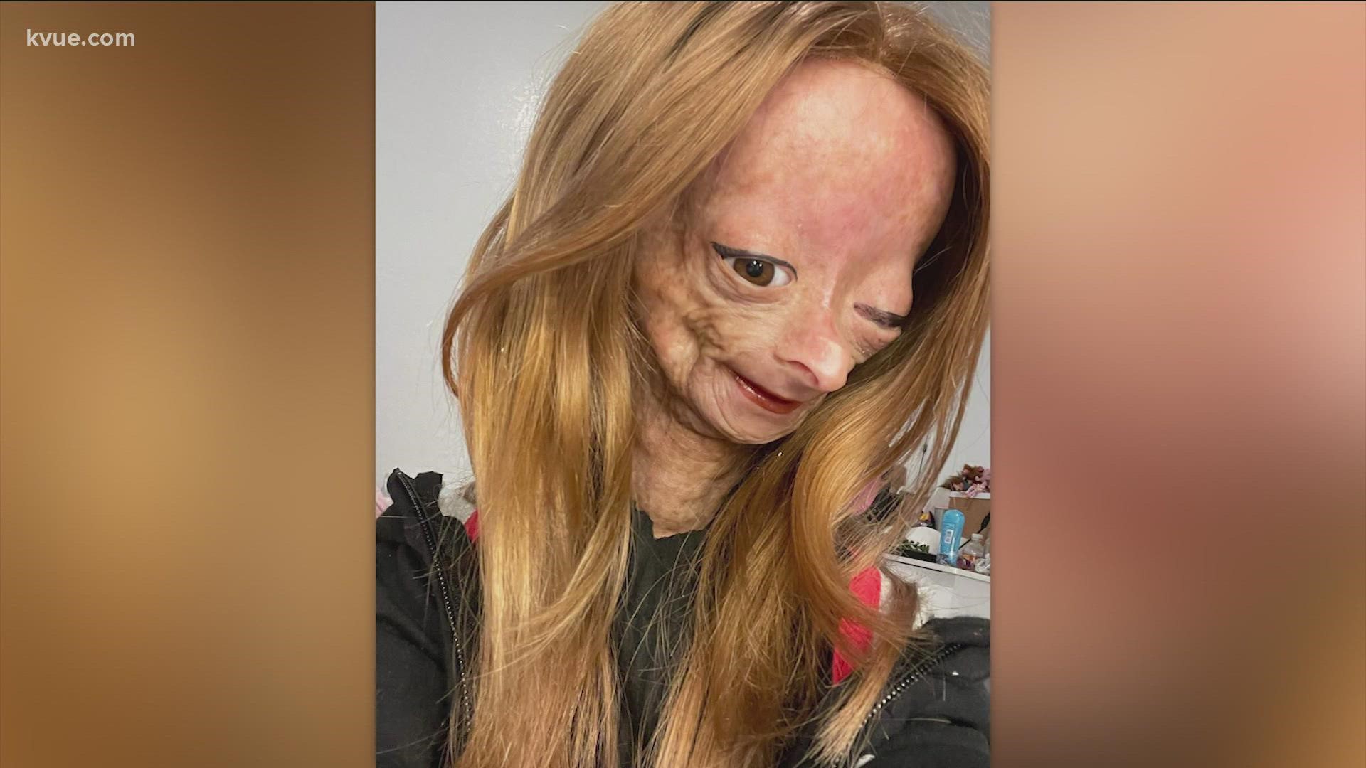 The social media star died at age 15 on Jan. 12. She had a rare genetic condition called Hutchinson-Gilford progeria syndrome, which causes premature aging.