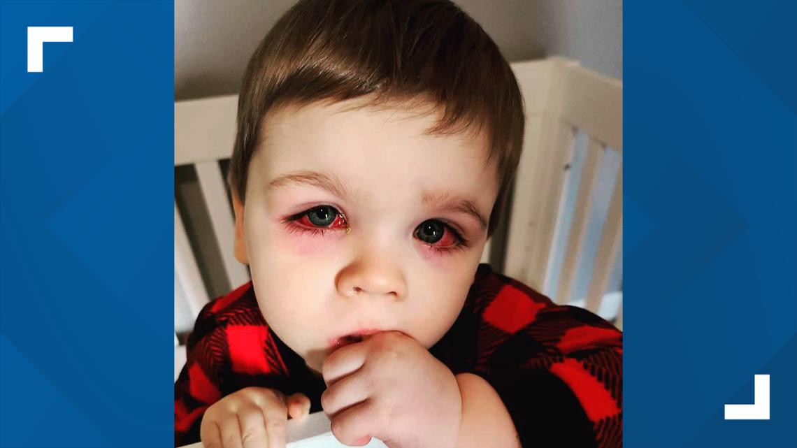 PHOTOS Toddler Catches Eye Infection After Using Bath Toy Kvue