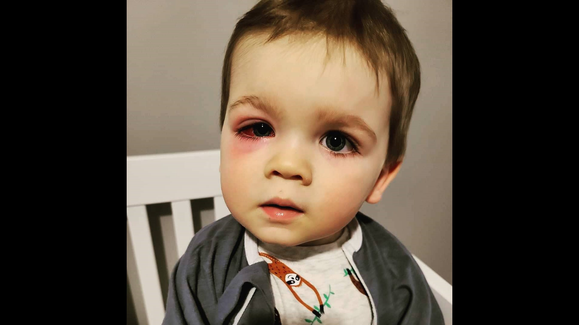 Toddler catches bacterial infection after squirting eye with water from ...