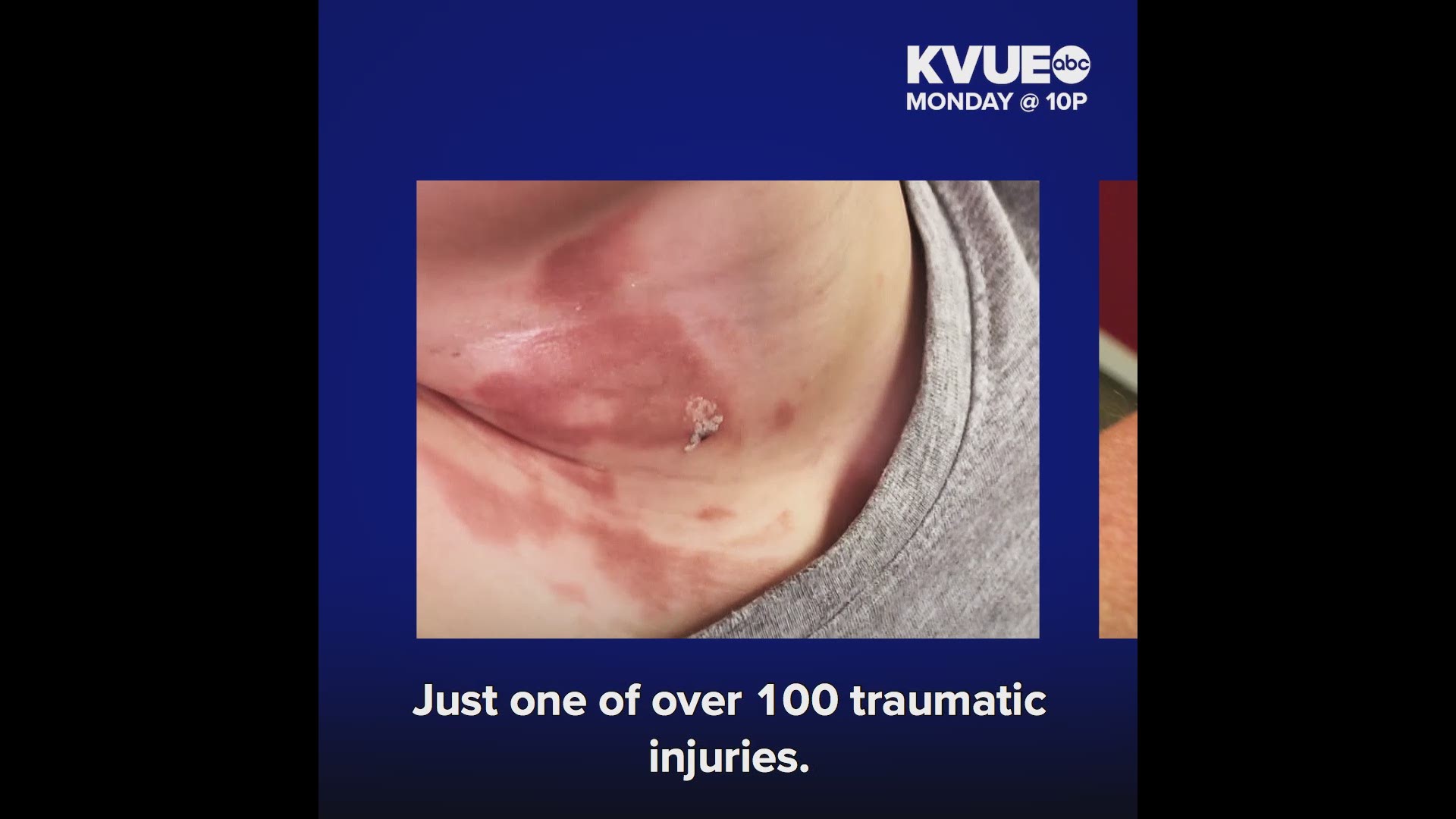 One girl's experience was just one of more than 100 traumatic injuries. Could it have been prevented? Tune in to KVUE at 10 p.m.