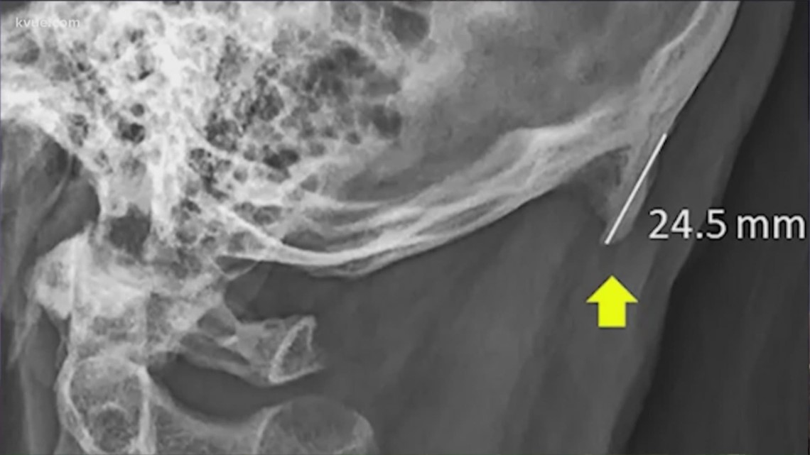 People are growing 'phone horns' due to phone use, researchers say