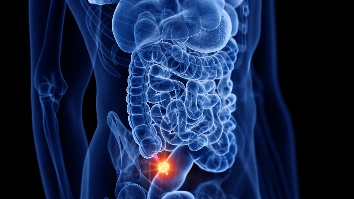 Appendix cancer rates surge among Gen X and millennials | kvue.com