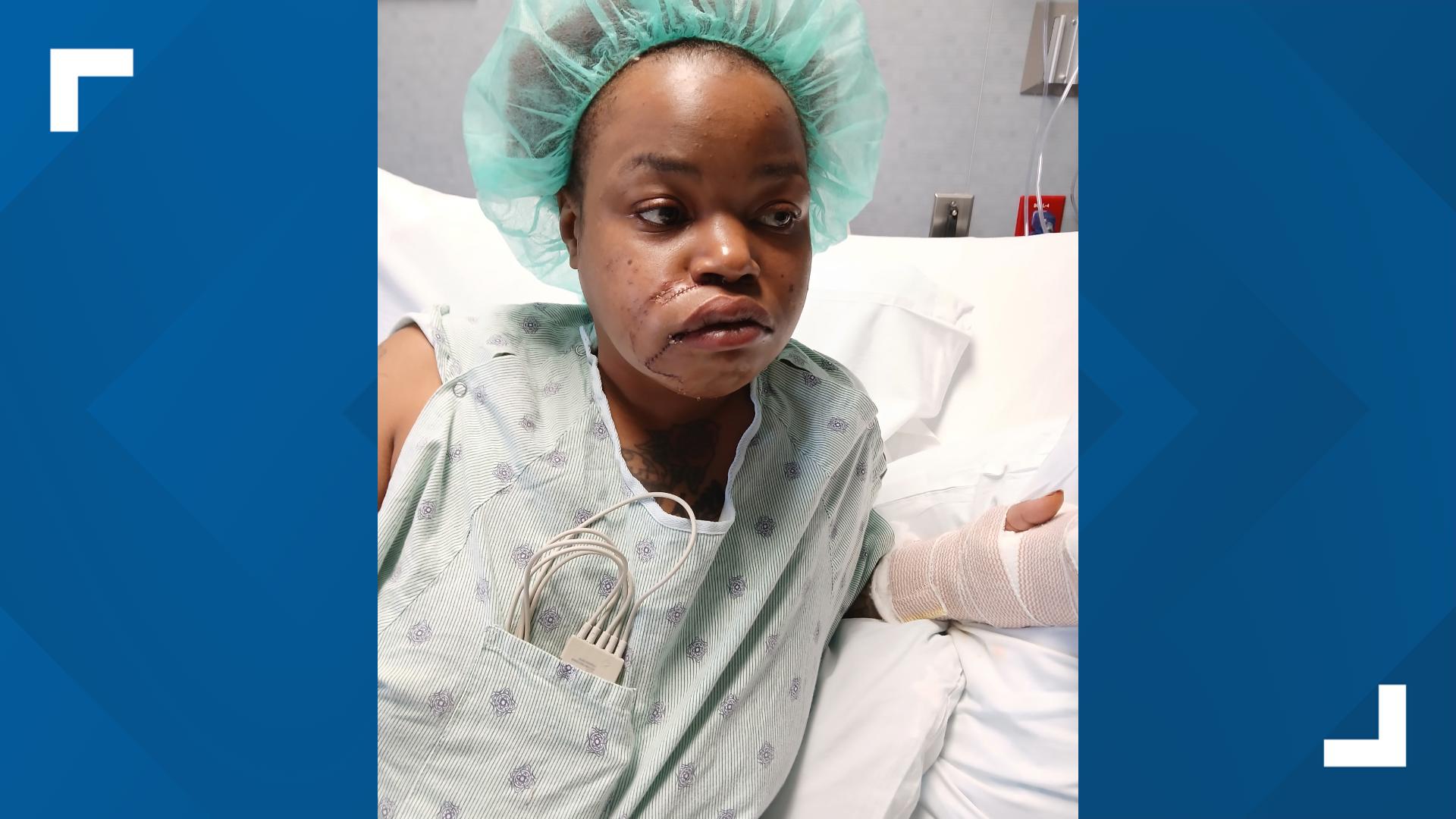 Dog that mauled North Texas woman had bitten someone before, Dallas ...